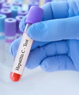 When Should I Get Tested for Hepatitis C?